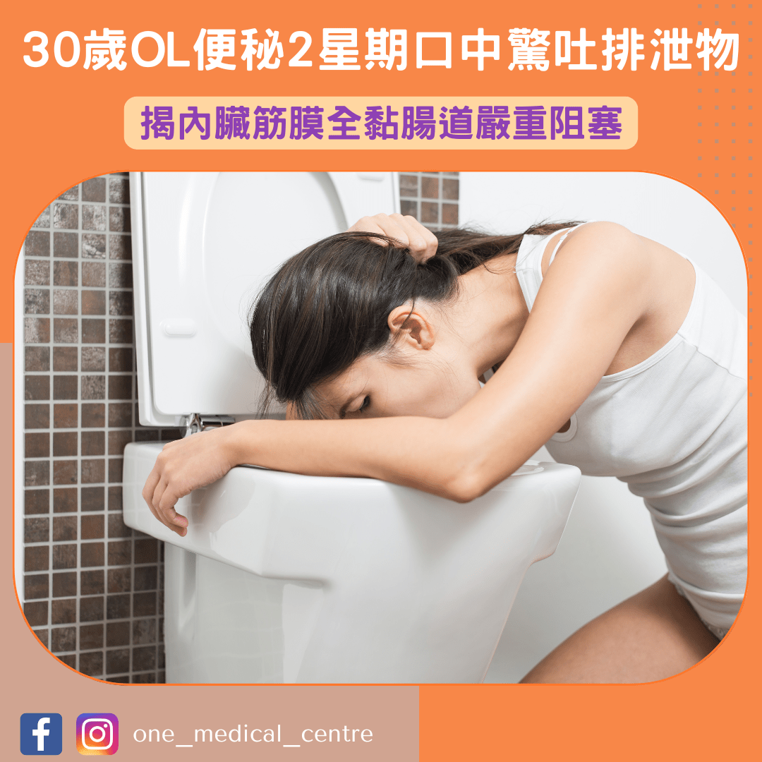 【30歲OL便秘2星期口中驚吐排泄物　揭內臟筋膜全黏腸道嚴重阻塞😨】